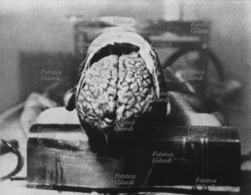 SHOAH dettaglio del cervello aperto di una cavia umana nel laboratorio medico del campo di Dachau. Si sperimentava, fino al decesso, la resistenza umana al vento caldo o freddo ricreando artificialmente alcune condizioni estreme nelle quali poteva trovarsi un soldato paracadutato. Germania, 1943.