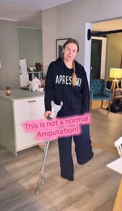 Woman becomes first to undergo state of the art amputation for future bionic leg Woman becomes first to undergo state of the art amputation for future bionic leg