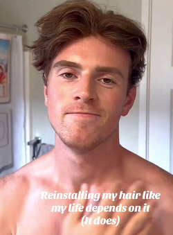 Ben Sherry Got a Toupee at 25 sharing his journey with the hair system on TikTok Ben Sherry Got a Toupee at 25 sharing his journey with the hair system on TikTok