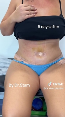 VIDEO Plastic surgeon reveals extreme tummy tuck transformations as viewers marvel at results