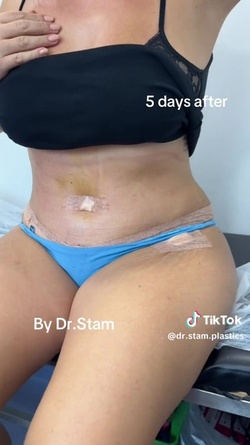 VIDEO Plastic surgeon reveals extreme tummy tuck transformations as viewers marvel at results