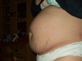 C section Hell