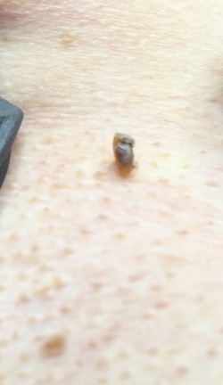 Blackhead removal video equally disgusts and satisfies users