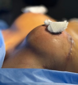 Influencer asks fans to bid thousands of pounds for her old breast implants