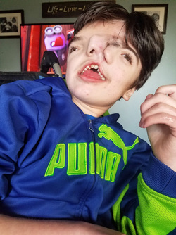 BOY WITH TWO FACES DEFIES ODDS BOY WITH TWO FACES DEFIES ODDS