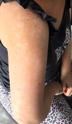 ALICE RING PSORIASIS
