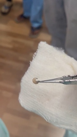 Boy three has WORM removed from his eye after it crawled inside Boy three has WORM removed from his eye after it crawled inside