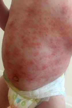MOTHER SPEAKS OUT AFTER HER SON CONTRACTED THE HERPES VIRUS THROUGH A KISS
