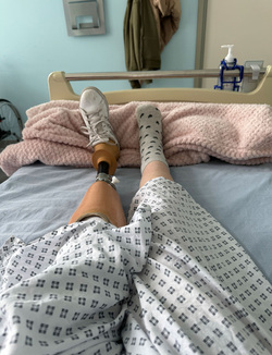 WALKING FOR THE FIRST TIME SINCE BECOMING A DOUBLE AMPUTEE