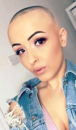 STUNNING ALOPECIA SUFFERER FINALLY BARES ALL DESPITE BULLIES ATTEMPTS TO SET HER WIG ON FIRE STUNNING ALOPECIA SUFFERER FINALLY BARES ALL DESPITE BULLIES ATTEMPTS TO SET HER WIG ON FIRE