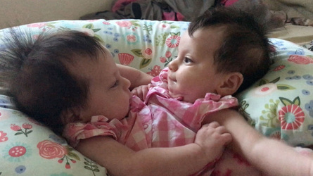 Conjoined Twins Defied Odds By Taking First Step And Living Their Best Life Conjoined Twins Defied Odds By Taking First Step And Living Their Best Life