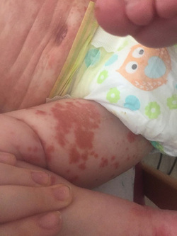 MOTHER SPEAKS OUT AFTER HER SON CONTRACTED THE HERPES VIRUS THROUGH A KISS