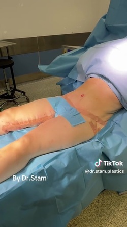 VIDEO Plastic surgeon reveals extreme tummy tuck transformations as viewers marvel at results