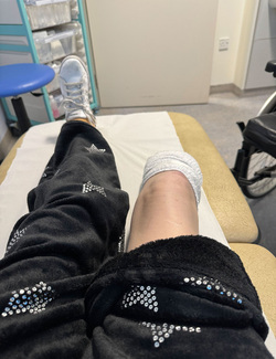 WALKING FOR THE FIRST TIME SINCE BECOMING A DOUBLE AMPUTEE