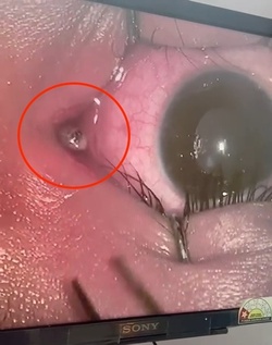 Boy three has WORM removed from his eye after it crawled inside Boy three has WORM removed from his eye after it crawled inside