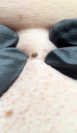 Blackhead removal video equally disgusts and satisfies users