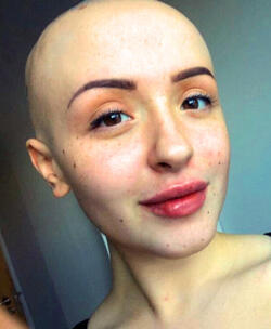 STUNNING ALOPECIA SUFFERER FINALLY BARES ALL DESPITE BULLIES ATTEMPTS TO SET HER WIG ON FIRE STUNNING ALOPECIA SUFFERER FINALLY BARES ALL DESPITE BULLIES ATTEMPTS TO SET HER WIG ON FIRE