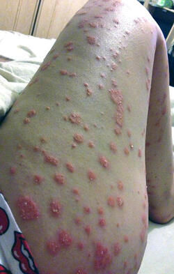 ALICE RING PSORIASIS