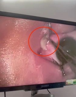Boy three has WORM removed from his eye after it crawled inside Boy three has WORM removed from his eye after it crawled inside