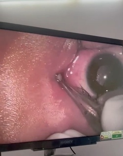 Boy three has WORM removed from his eye after it crawled inside Boy three has WORM removed from his eye after it crawled inside