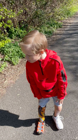 Tyson Fury Signed My Prosthetic Leg Tyson Fury Signed My Prosthetic Leg