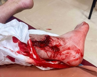 VIDEO Brit holidaymaker has leg sliced open and broken in horror crash with scooter while out jogging