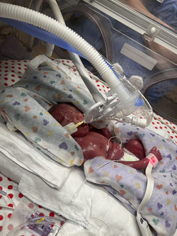 I THOUGHT MY BABY WAS GOING TO DIE WHEN MY WATERS BROKE AT 16 WEEKS