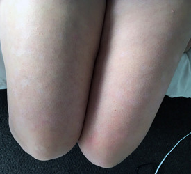 ALICE RING PSORIASIS