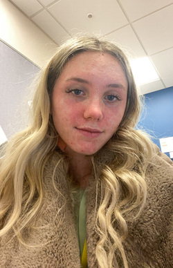 WOMAN CLAIMS SOCIAL MEDIA HELPED HER COME TO TERMS WITH HER PSORIASIS AND LOVE HERSELF