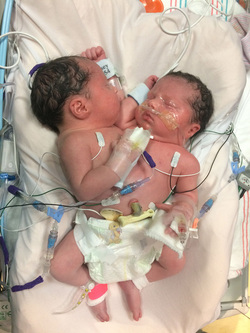 Conjoined Twins Defied Odds By Taking First Step And Living Their Best Life Conjoined Twins Defied Odds By Taking First Step And Living Their Best Life