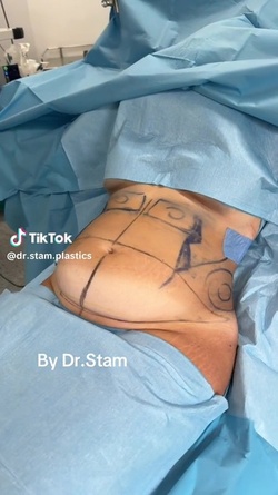 VIDEO Plastic surgeon reveals extreme tummy tuck transformations as viewers marvel at results