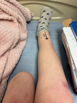 WALKING FOR THE FIRST TIME SINCE BECOMING A DOUBLE AMPUTEE