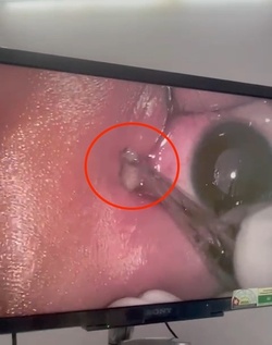 Boy three has WORM removed from his eye after it crawled inside Boy three has WORM removed from his eye after it crawled inside