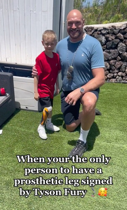 Tyson Fury Signed My Prosthetic Leg Tyson Fury Signed My Prosthetic Leg