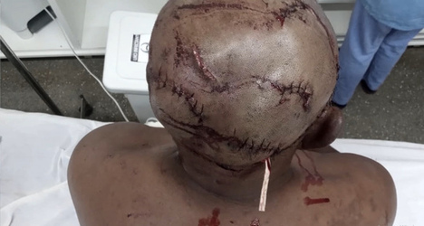 CLAW BLIMEY Horrific Injuries Of Man Who Grappled With Wild Jaguar To Save Nephews