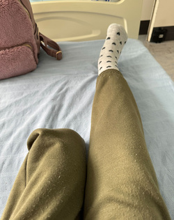 WALKING FOR THE FIRST TIME SINCE BECOMING A DOUBLE AMPUTEE