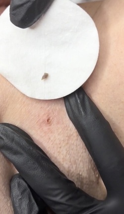 Blackhead removal video equally disgusts and satisfies users